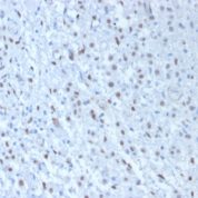 FFPE human mesothelioma sections stained with 100 ul anti-Wilms Tumor 1 (clone WT1/857 + 6F-H2) at 1:50. HIER epitope retrieval prior to staining was performed in 10mM Citrate, pH 6.0.